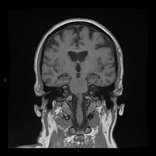 Cerebellar abscess (Radiopaedia 78135-90678 Coronal T1 C+ 84).jpg