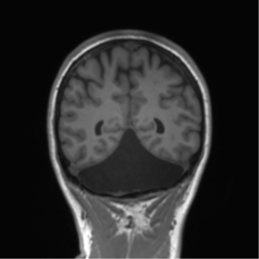 Cerebellar agenesis with hypoplastic pons (pontocerebellar hypoplasia) (Radiopaedia 57224-64138 Coronal T1 28).png