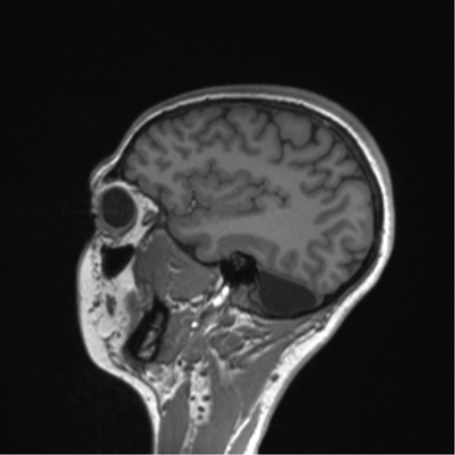 File:Cerebellar agenesis with hypoplastic pons (pontocerebellar hypoplasia) (Radiopaedia 57224-64138 Sagittal T1 22).png