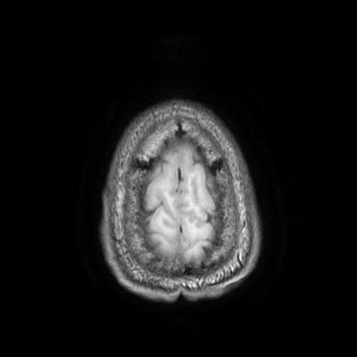 File:Cerebellar hemangioblastoma (Radiopaedia 88055-104622 Axial T1 32).jpg