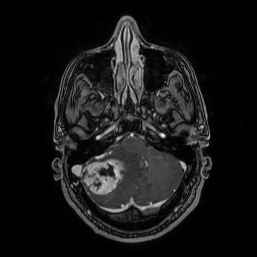File:Cerebellar hemangioblastoma (Radiopaedia 88055-104622 Axial T1 C+ 52).jpg