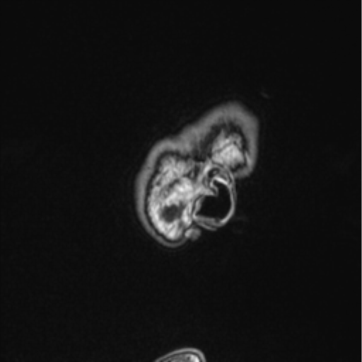 Cerebellar hemangioblastomas and pituitary adenoma (Radiopaedia 85490-101176 Sagittal T1 90).png