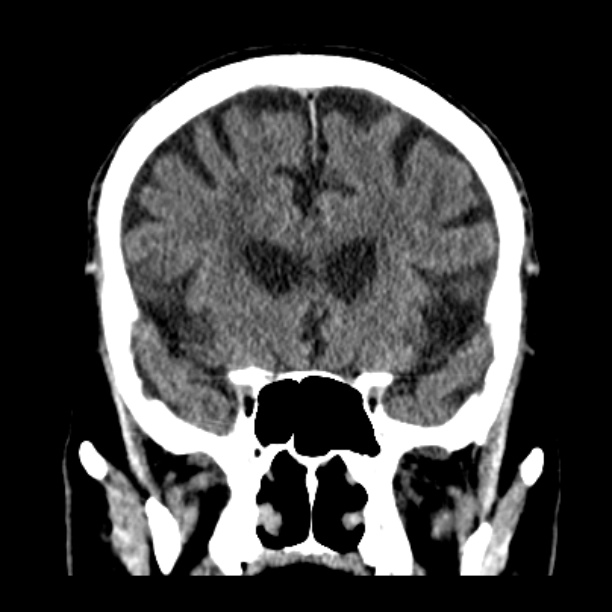 Cerebellar hemorrhage (Radiopaedia 27193-27359 Coronal non-contrast 21).jpg