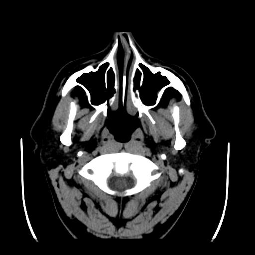 File:Cerebellar infarction (Radiopaedia 16625-16327 Axial non-contrast 1).jpg