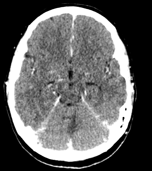 Cerebellar metastases - colorectal adenocarcinoma (Radiopaedia 40947-43652 Axial C+ 21).png