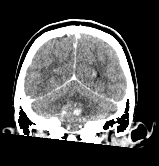 Cerebellar metastases - colorectal adenocarcinoma (Radiopaedia 40947-43652 Coronal C+ 68).png