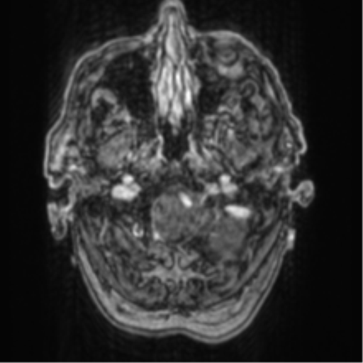 File:Cerebellar metastasis from lung adenocarcinoma (Radiopaedia 86690-102829 Axial T1 C+ 12).png