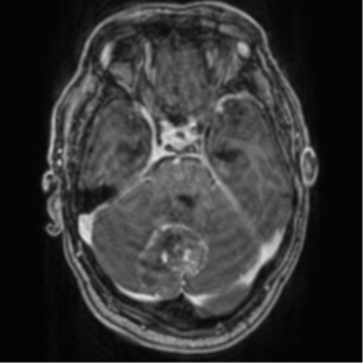 Cerebellar metastasis from lung adenocarcinoma (Radiopaedia 86690-102829 Axial T1 C+ 27).png