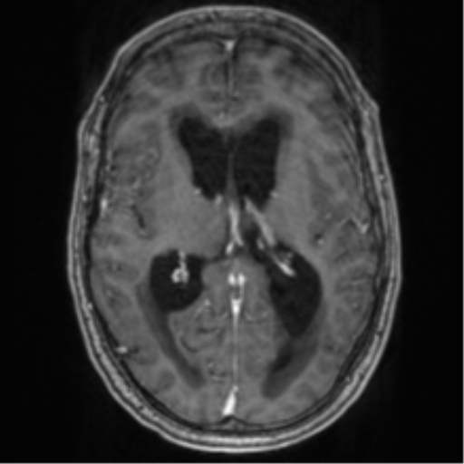 Cerebellar metastasis from lung adenocarcinoma (Radiopaedia 86690-102829 Axial T1 C+ 44).png