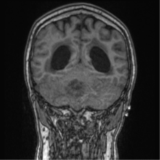 File:Cerebellar metastasis from lung adenocarcinoma (Radiopaedia 86690-102829 Coronal T1 34).png