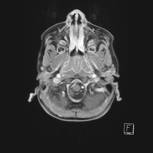 Cerebellar stroke (Radiopaedia 32202-33150 Axial T1 C+ 17).png