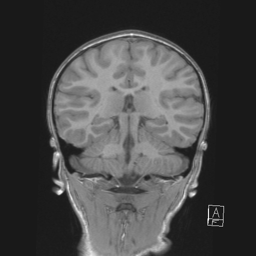 Cerebellar stroke (Radiopaedia 32202-33150 Coronal T1 37).png