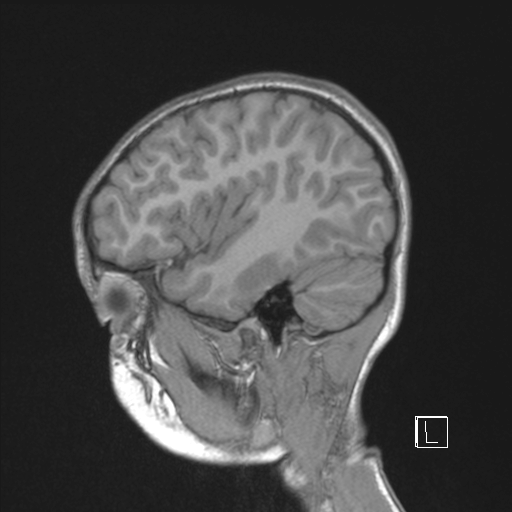 Cerebellar stroke (Radiopaedia 32202-33150 Sagittal T1 C+ 41).png