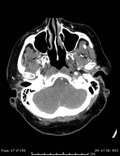 Cerebellar strokes due to intracranial giant cell arteritis (Radiopaedia 68799-78510 CT angiogram 67).jpg