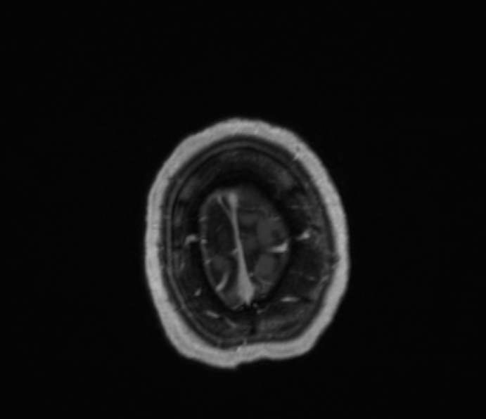 Cerebellopontine angle meningioma (Radiopaedia 35181-36715 Axial T1 C+ 7).jpg