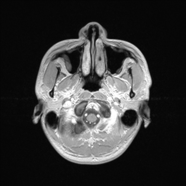 Cerebral abscess (Radiopaedia 24212-24478 Axial T1 C+ 10).jpg
