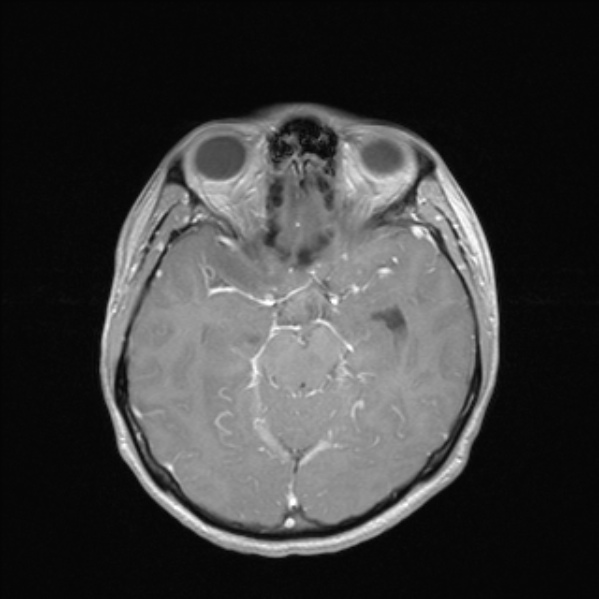 Cerebral abscess (Radiopaedia 24212-24478 Axial T1 C+ 26).jpg