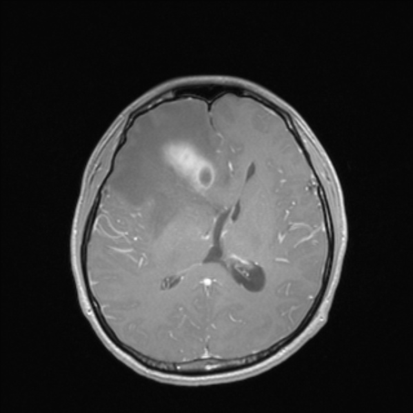 Cerebral abscess (Radiopaedia 24212-24478 Axial T1 C+ 35).jpg