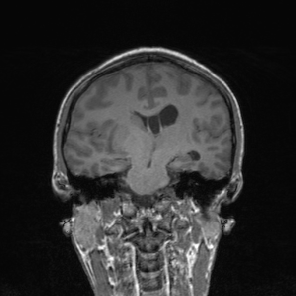 Cerebral abscess (Radiopaedia 24212-24478 Coronal T1 118).jpg