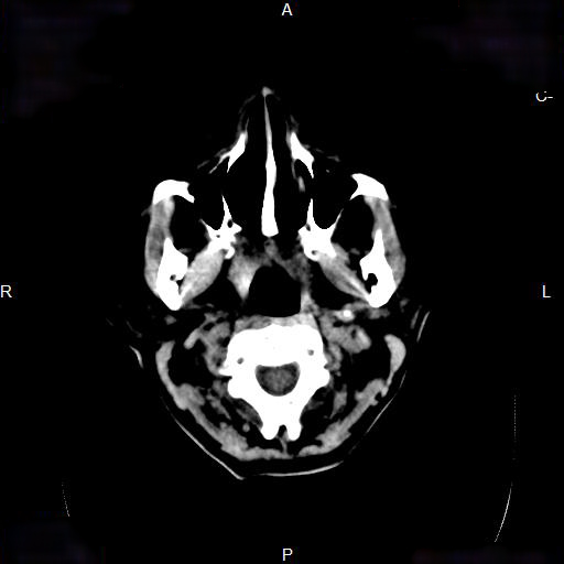 File:Cerebral abscess (Radiopaedia 7606-8431 Axial non-contrast 3).jpg