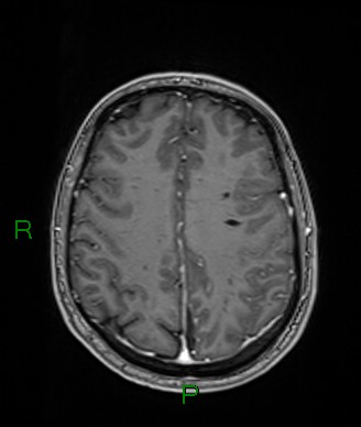 Cerebral abscess and subdural empyema (Radiopaedia 84436-99779 Axial T1 C+ 29).jpg