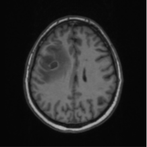 Cerebral abscess from pulmonary arteriovenous malformation (Radiopaedia 86275-102291 Axial T1 50).png