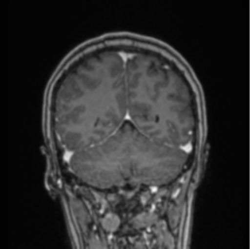 Cerebral abscess from pulmonary arteriovenous malformation (Radiopaedia 86275-102291 L 27).png