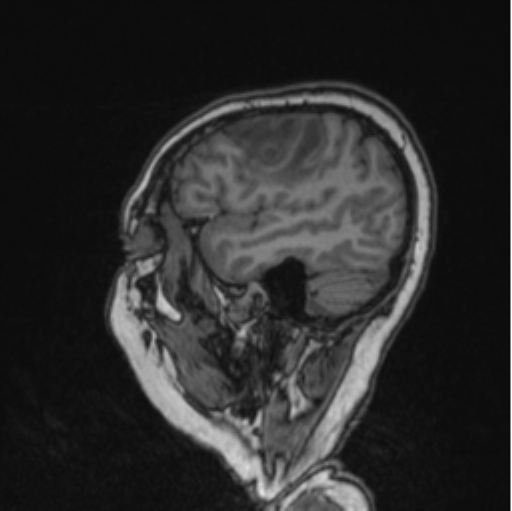 Cerebral abscess from pulmonary arteriovenous malformation (Radiopaedia 86275-102291 Sagittal T1 75).png