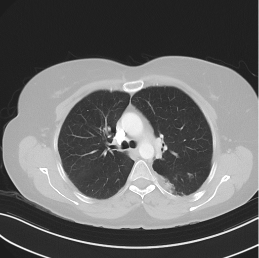 File:Cerebral abscess from pulmonary arteriovenous malformation (Radiopaedia 86275-102292 Axial lung window 23).png