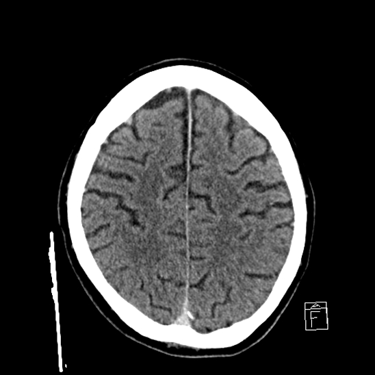 File:Cerebral abscess with ventriculitis (Radiopaedia 78965-91877 A 35).jpg
