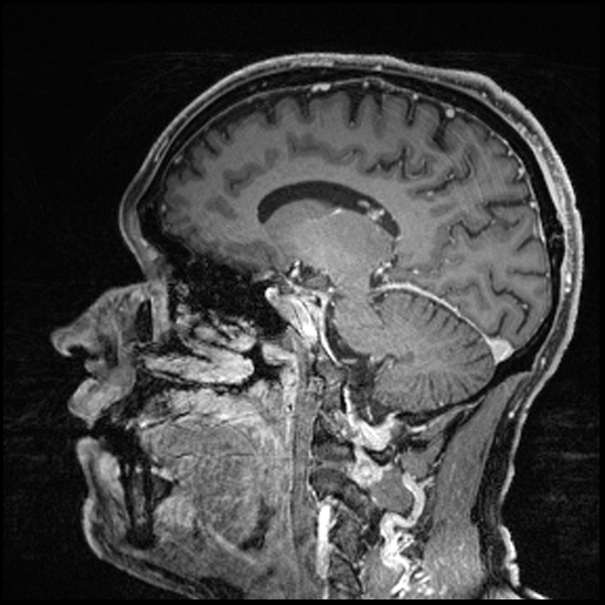 Cerebral abscess with ventriculitis (Radiopaedia 78965-91878 Sagittal T1 C+ 78).jpg