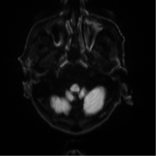 File:Cerebral amyloid angiopathy (Radiopaedia 46082-50433 Axial DWI 29).png