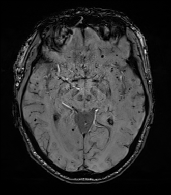 File:Cerebral amyloid angiopathy (Radiopaedia 46082-50433 Axial SWI 37).png