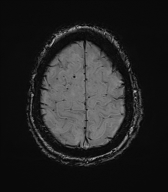 File:Cerebral amyloid angiopathy (Radiopaedia 46082-50433 Axial SWI 73).png