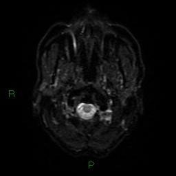 File:Cerebral amyloid angiopathy (Radiopaedia 77506-89664 Axial DWI 30).jpg