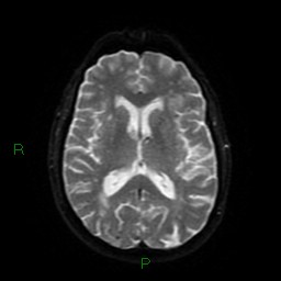 File:Cerebral amyloid angiopathy (Radiopaedia 77506-89664 Axial DWI 44).jpg