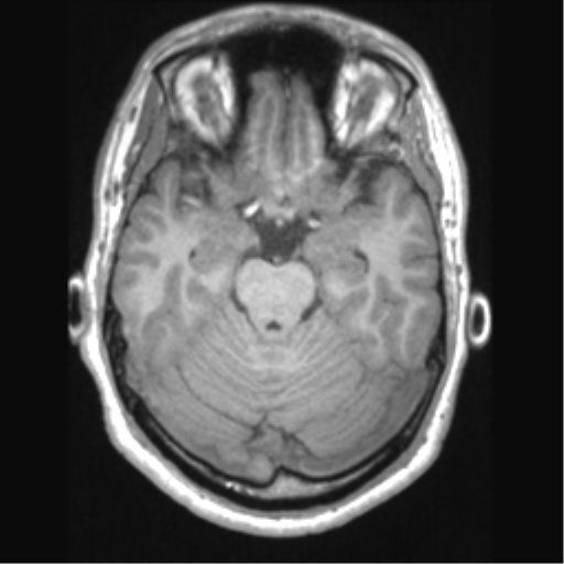 Cerebral arteriovenous malformation (Radiopaedia 39259-41506 Axial T1 28).png