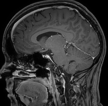 Cerebral arteriovenous malformation (Radiopaedia 74411-85654 Sagittal T1 C+ 60).jpg