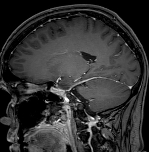Cerebral arteriovenous malformation (Radiopaedia 74411-85746 Sagittal T1 C+ 49).jpg