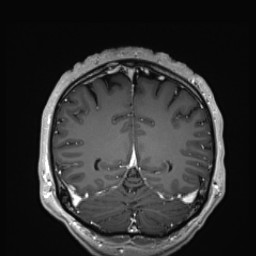 Cerebral arteriovenous malformation (Radiopaedia 84015-99245 Coronal T1 C+ 124).jpg