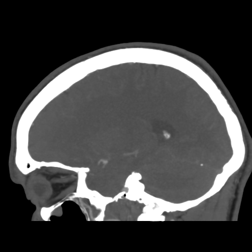 Cerebral arteriovenous malformation (Spetzler-Martin grade 2) (Radiopaedia 41262-44076 G 36).png