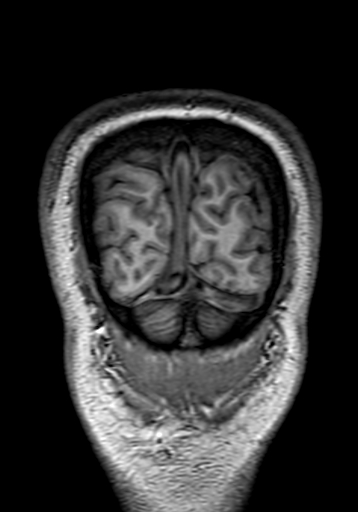 Cerebral arteriovenous malformation at posterior body of corpus callosum (Radiopaedia 74111-84925 Coronal T1 329).jpg
