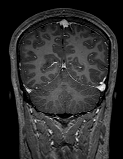 Cerebral arteriovenous malformation at posterior body of corpus callosum (Radiopaedia 74111-84925 K 278).jpg