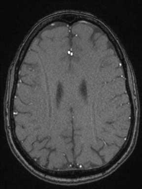Cerebral arteriovenous malformation with hemorrhage (Radiopaedia 34422-35737 Axial MRA 57).png