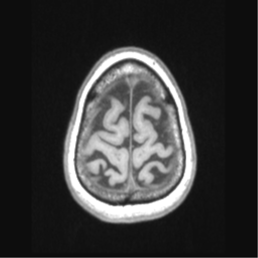 Cerebral arteriovenous malformation with hemorrhage (Radiopaedia 34422-35737 Axial T1 68).png