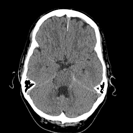 Cerebral arteriovenous malformation with lobar hemorrhage (Radiopaedia 35598-37117 Axial non-contrast 16).jpg