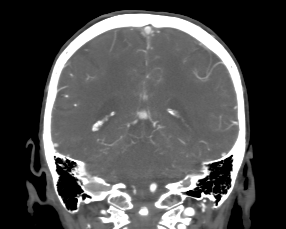 Cerebral arteriovenous malformation with lobar hemorrhage (Radiopaedia 44725-48511 A 39).png