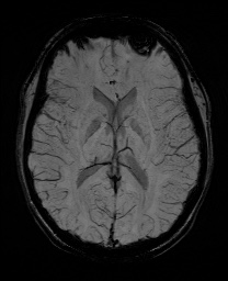 Cerebral cavernous venous malformation (Radiopaedia 70008-80021 Axial SWI 37).jpg