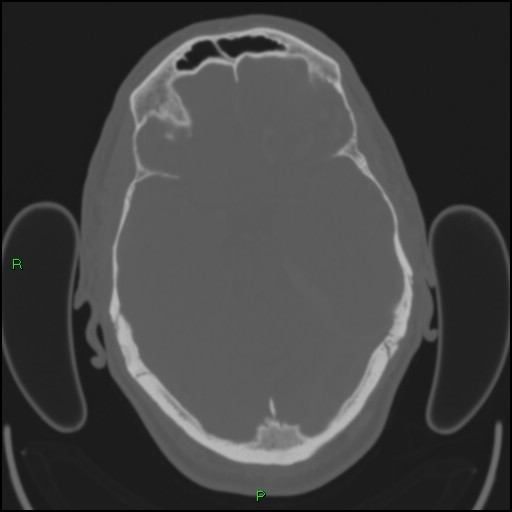 Cerebral contusions (Radiopaedia 33868-35039 Axial bone window 73).jpg