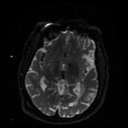 Cerebral embolic infarcts (embolic shower) (Radiopaedia 49837-55108 Axial DWI 26).jpg